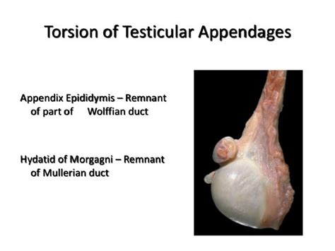 torsion of the appendix testes|Appendix Testis (Hydatid of Morgagni) .